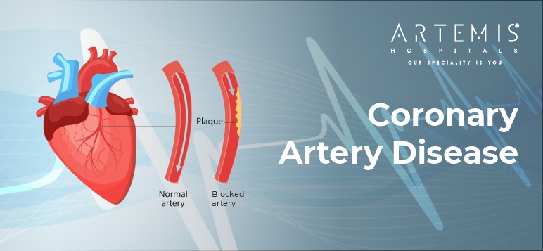 coronary-artery-disease-symptoms-causes-and-treatment