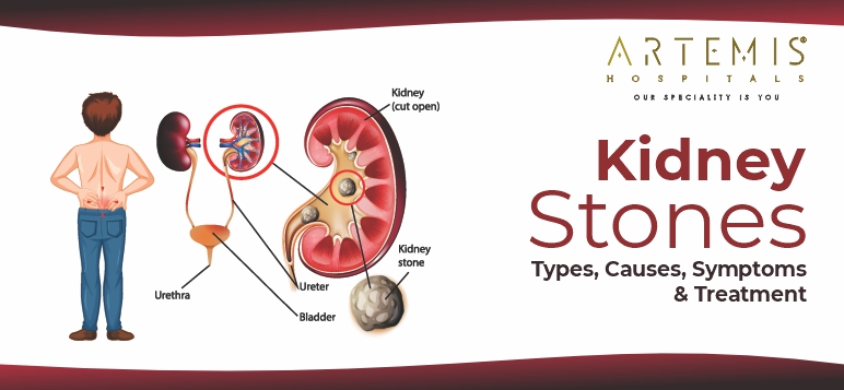 kidney-stones-types-causes-symptoms-and-treatment-options