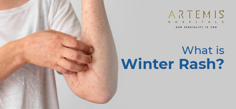 what-is-winter-rash-its-causes-prevention